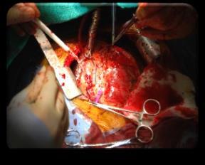 (appendectomy, cholecystectomy, hernia
