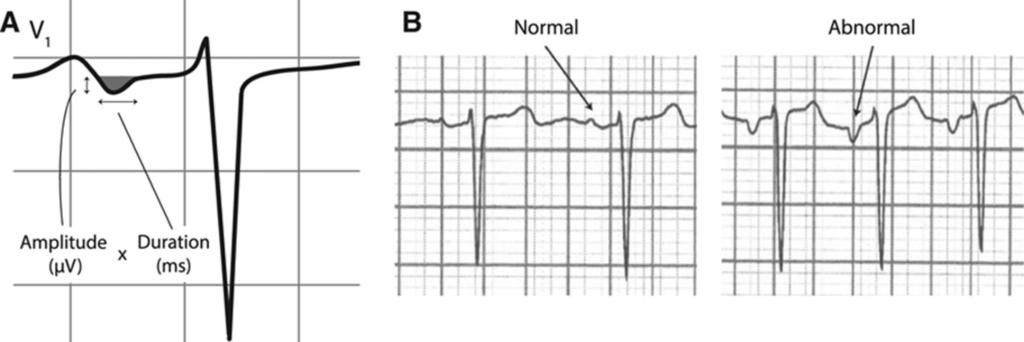 Association of Abnormal P-wave Morphology with Incident Stroke Multi-Ethnic Study of Atherosclerosis