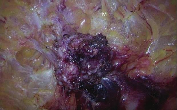 The role of single port surgery in Crohn s disease anastomotic leakage after IPAA can consist of surgical closure of the defect after Endosponge therapy of the presacral cavity.