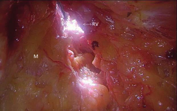 fat, R closed rectum, RV rendez-vous point) Figure 3: