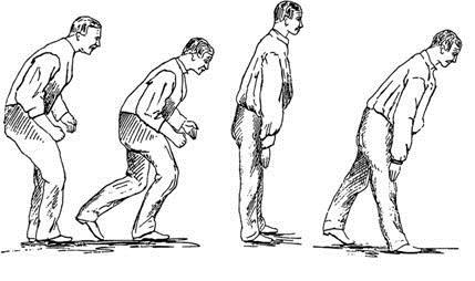 Abnormal Gait & Posture 14 Asymmetrical Gait Slow to start walking Shortened stride Stiff legged gait-rigidity comes through on one side, therefore difficult clearing swinging on one side Rapid,