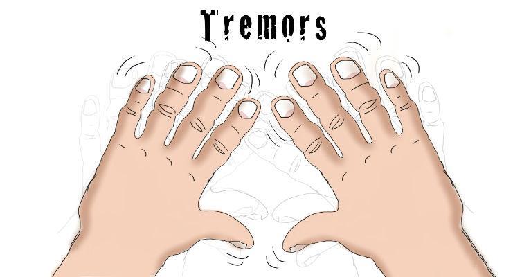 Essential Tremor Essential tremor is a nervous system (neurological) disorder that causes involuntary and rhythmic shaking.
