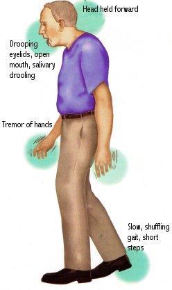 Symptom: Tremor Tremor is an early symptom for about 70% of people with Parkinson's. It usually starts in a finger or hand when the hand is at rest, but not when the hand is in use.