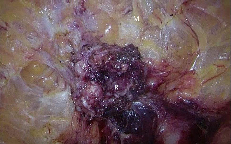 2280 World J Surg (2016) 40:2276 2282 Fig. 1 Proctocolectomy and pouch creation with TAMIS in a 50-year-old female patient with therapy refractory UC.
