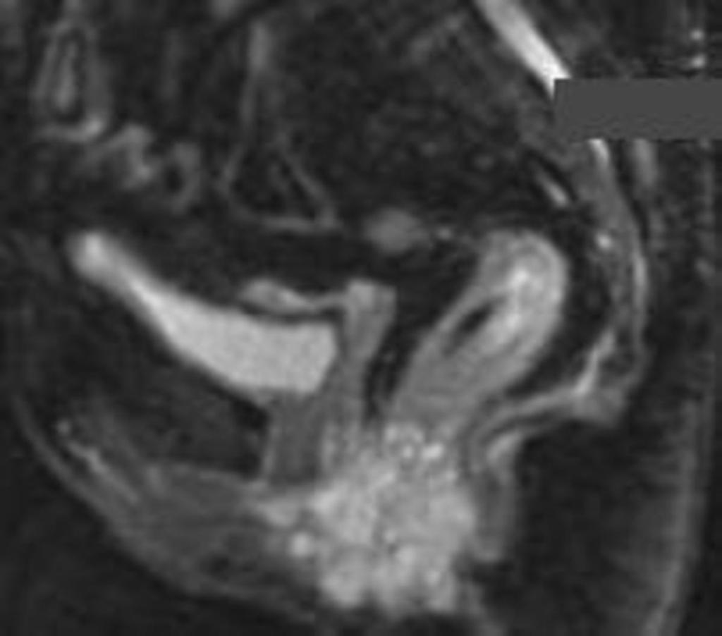 Fig. 4: Sagittal STIR image of a 48-year-old female with agressive PCD with complex fistula to the rectovaginal septum and a
