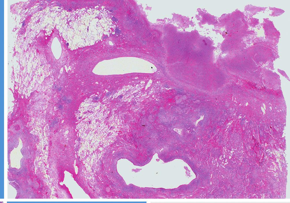 59 Pathology of Nontuberculous Mycobacterial Pulmonary Infection A C D B E F Fig. 1.