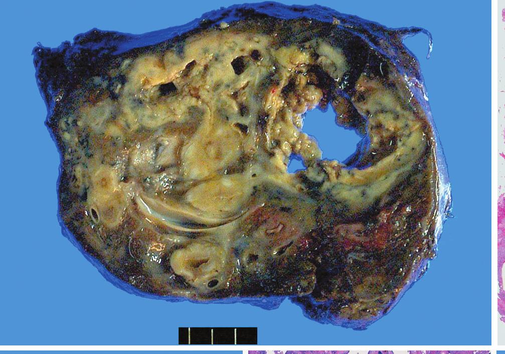 dilatated bronchi (A, B). Pneumonectomy specimen shows severely destroyed lung with saccular and cylindrical bronchiectasis with caseating granulomas in bronchial wall (C-F).