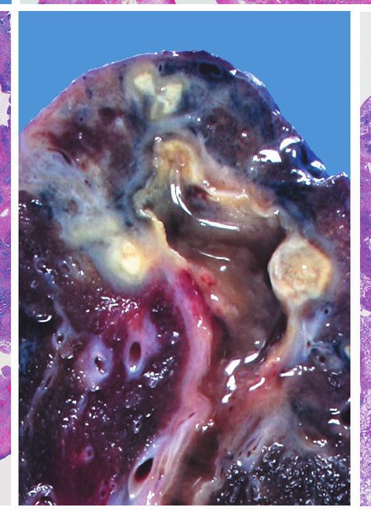 main lesion and the relatively preserved bronchi (Fig. 1B).