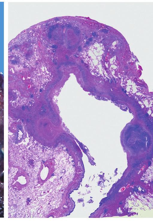 Pneumonia-like granulomatous lesions with ill-defined gran- ulomas, epithelioid cells and fibroblastic interstitial reaction were identified in 25 cases (Fig. 2G, H).