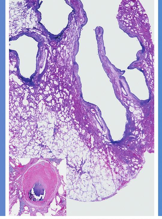 granuloma (A, B with inset; Mycobacterium abscessus [M. abscessus]), and parenchymal discrete granulomas (C, D; M.
