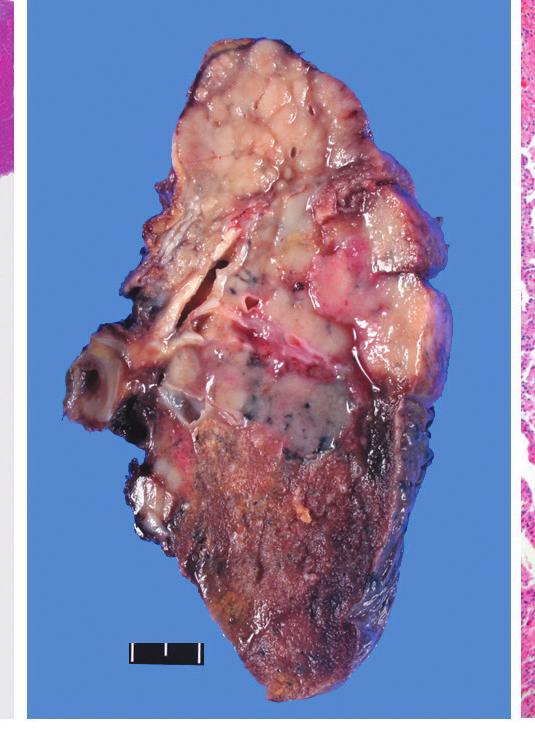 bronchiectasis and the histological features of granulomatous inflammation were evaluated. The specimens infected by the M.