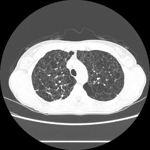 Lung Transplant Case Presentation Errol L.