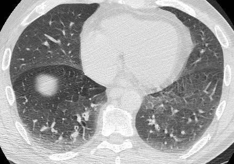 Is pulmonary CT a useful diagnostic reference