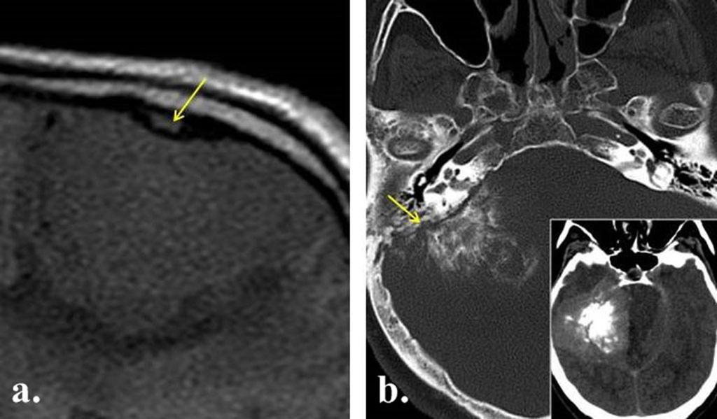 Fig. 10: a. T1-weighted image shows bone hyperostosis (arrow) adjacent to a convexity meningioma. b. CT scan shows bone lysis (arrow) due to a psammomatous meningioma.