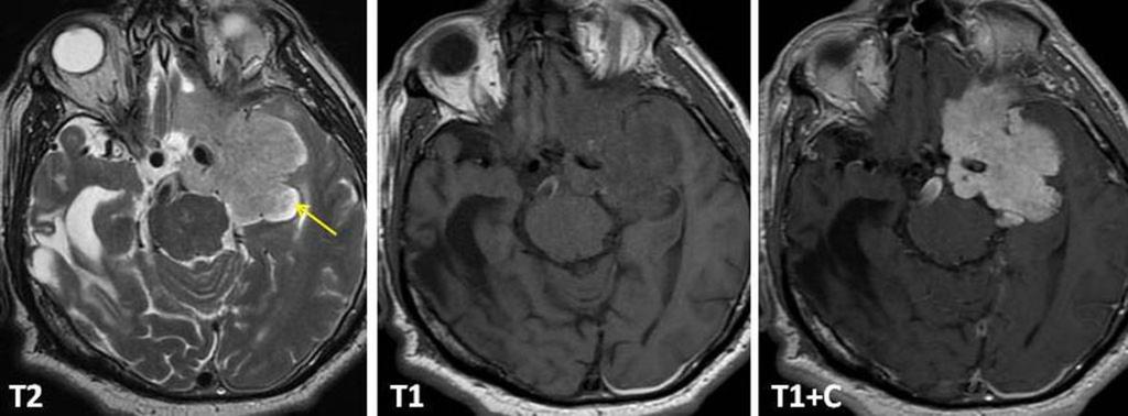 Fig. 12: Intra-axial brain metastases showing ring enhancement (arrows).