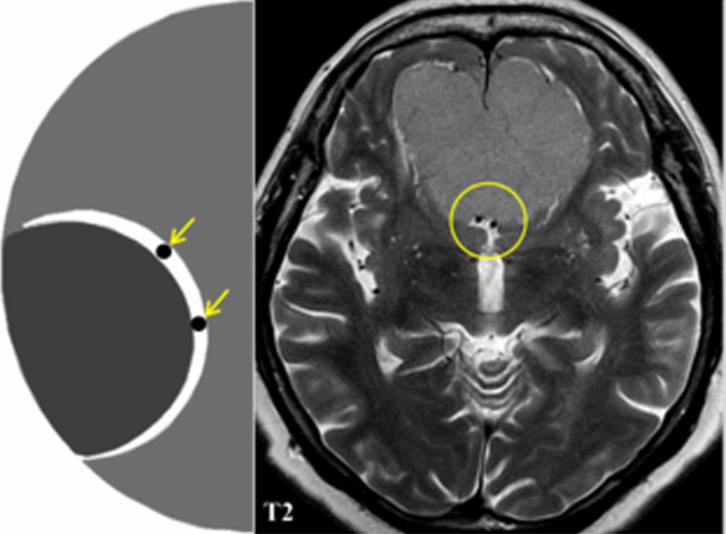 Fig. 2: The drawing illustrates a CSF cleft (arrow) interposed between the extra-axial lesion and the brain parenchyma.