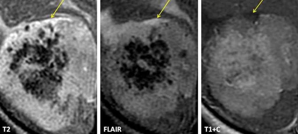 Fig. 4: CSF cleft (arrows) on T2, FLAIR, and T1-weighted images.