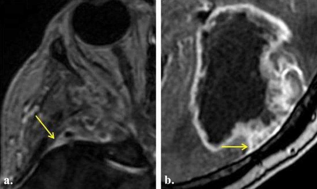 Fig. 9: a. Anaplastic meningioma with intraorbital extension showing adjacent dural enhancement (arrow). b.