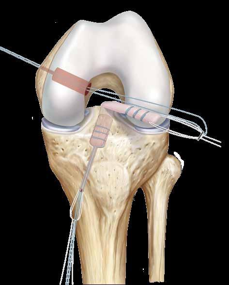 2 The graft is inserted deeply into the tibial socket to facilitate passage of the