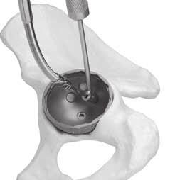The bone screw must be fully seated to ensure engagement of the trial liner or