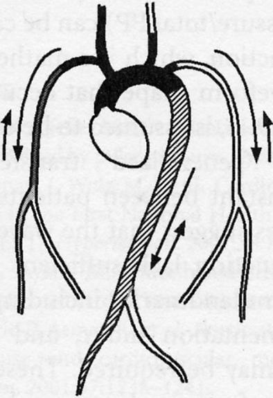 Regional Assessment of Arterial Properties Central Conduit Stiffness = Characteristic Impedence =