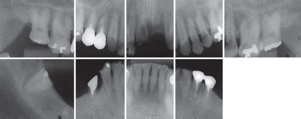 IJOPRD Infraocclusion Treated with Removable Prosthesis on Occlusal Surface of Severely Attritioned Teeth Fig.