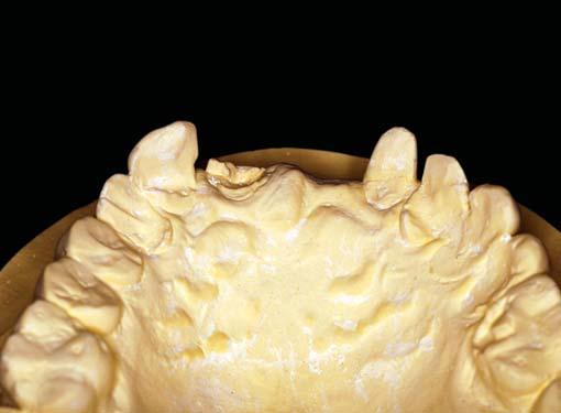 3: Detached fixed partial denture and fractured upper right central incisor (at initial examination) Fig.