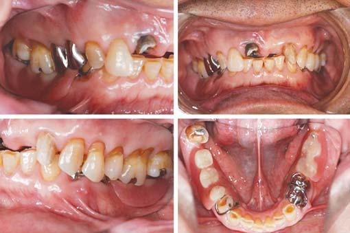 Akinori Tasaka et al Fig. 4: Intraoral photographs of with dentures (at initial examination) Fig.