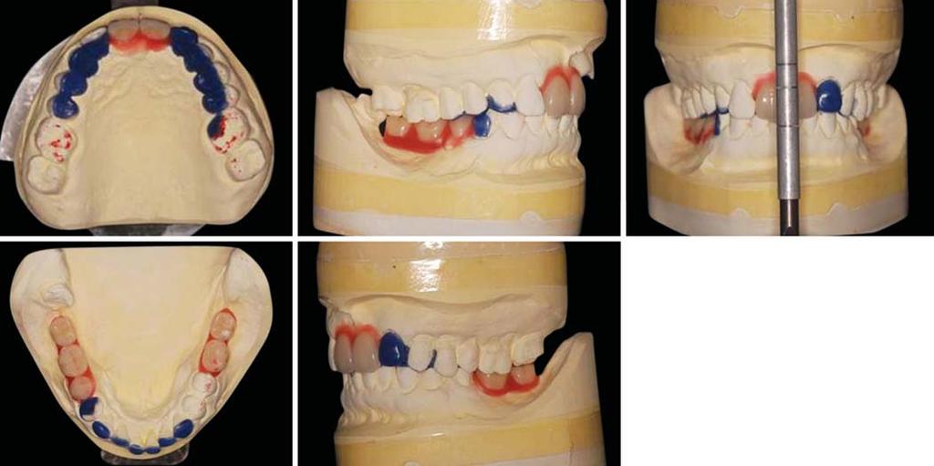 However, the patient was reluctant to undergo the suggested treatment after it was explained that it would be necessary to cut and carry out pulpectomy of multiple teeth if crown restoration was