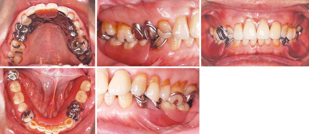 Akinori Tasaka et al Fig. 9: Intraoral photographs of with definitive prosthesis applied 3 months. Plaque control and cleaning of the dentures are being practiced adequately.