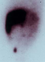 hematologic diseases Huge splenomegaly (> 25 cm) Malignant splenic tumor. pericapsular inflammation.