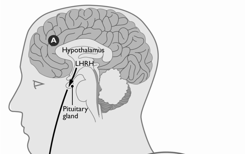 Continuous (-) LHRH agonists The hypothalamus situated in the brain is stimulated to produce pulses of Luteinizing Hormone Releasing Hormone (LHRH) A.