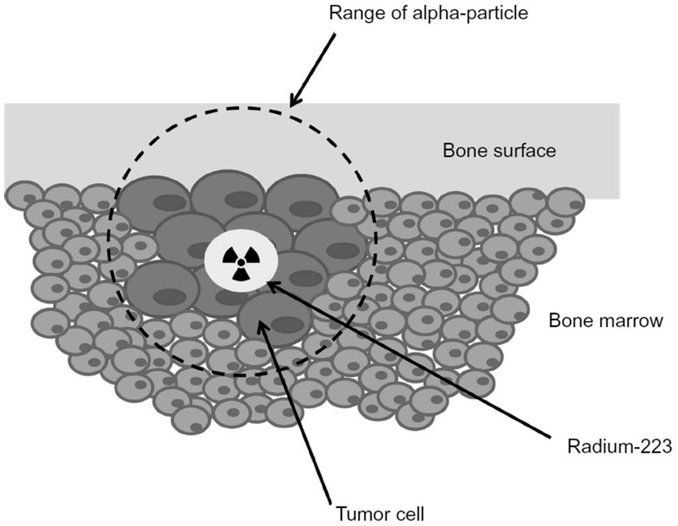 Radium-223 For patients with symptomatic bone only disease Radium-223 is an alpha-emitting radiopharmaceutical that selectively binds to areas of bone metastases.