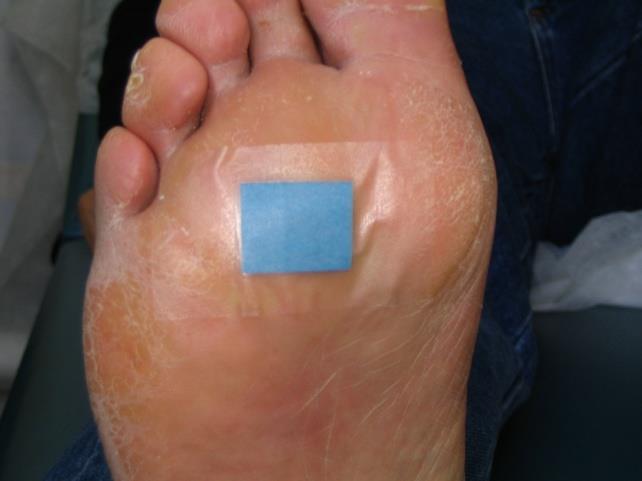 Dryness of the skin of the feet Method for the assessment of skin