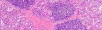 of proceeding directly to surgery However, the accuracy of molecular testing may be lower for FNAs of oncocytic lesions There is an