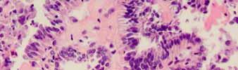 Cyst-lining cells Ciliated glandular cells from