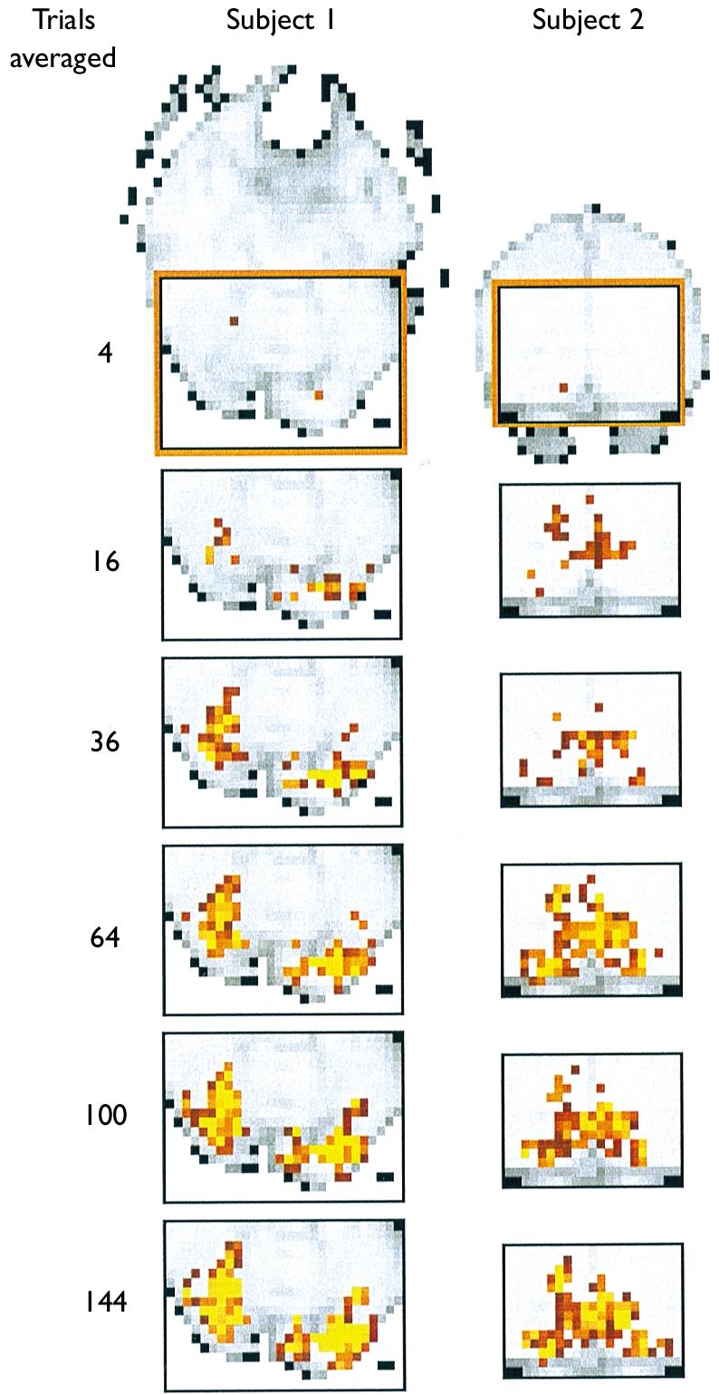NEUROREPORT S. A. HUETTEL AND G. McCARTHY Fig.. Changes in the spatial topography of activation with increasing numbers of trials.