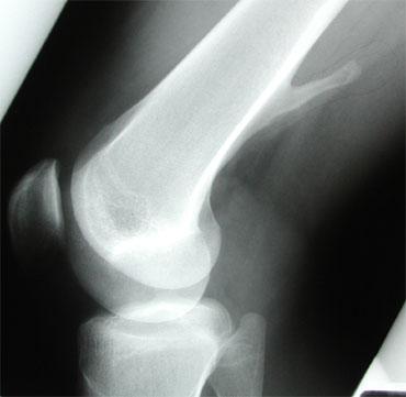 Osteosarcoma-Clinical Age 10-20 years H/O dull pain for several months which suddenly gets worse secondary to