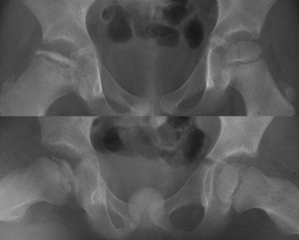 Legg-Calves-Perthes Disease Idiopathic Avascular Necrosis of the