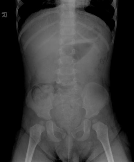Peak age 5 mo-2 years Clinical presentation Intussusseption