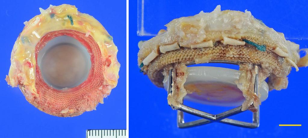 Note the mild extension of the firinous tissue over the ring (yellow rrows).