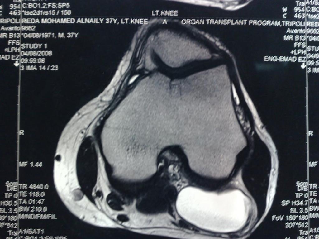 A Large popliteal cyst at postero-lateral aspect of the lateral femoral condyle of the knee