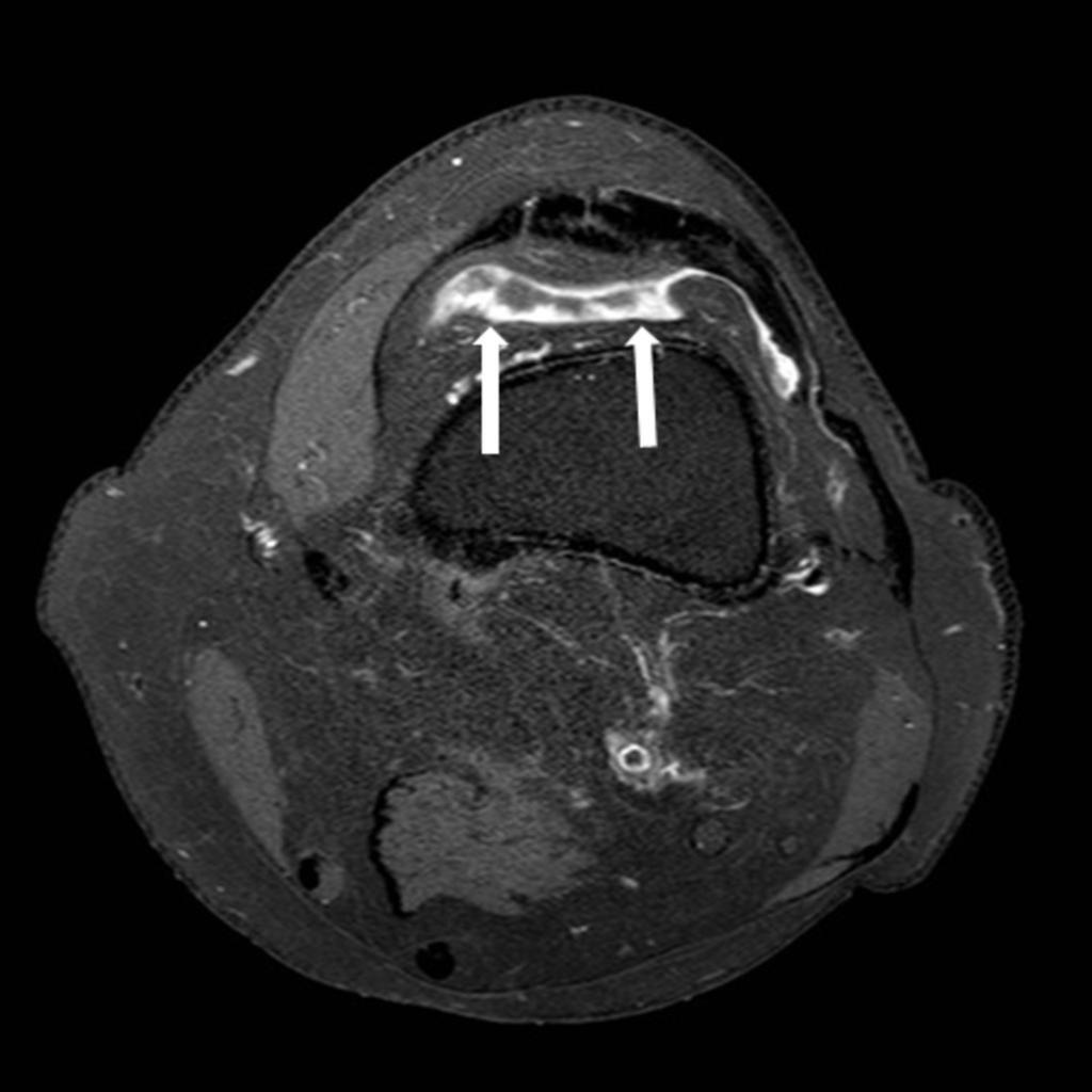 Fig. 4: 4.Synovitis. Gadolinium-enhanced T1 SPIR image of the knee shows nodular enhanced foci of increased synovial thickness in a patient with tophaceous gout.