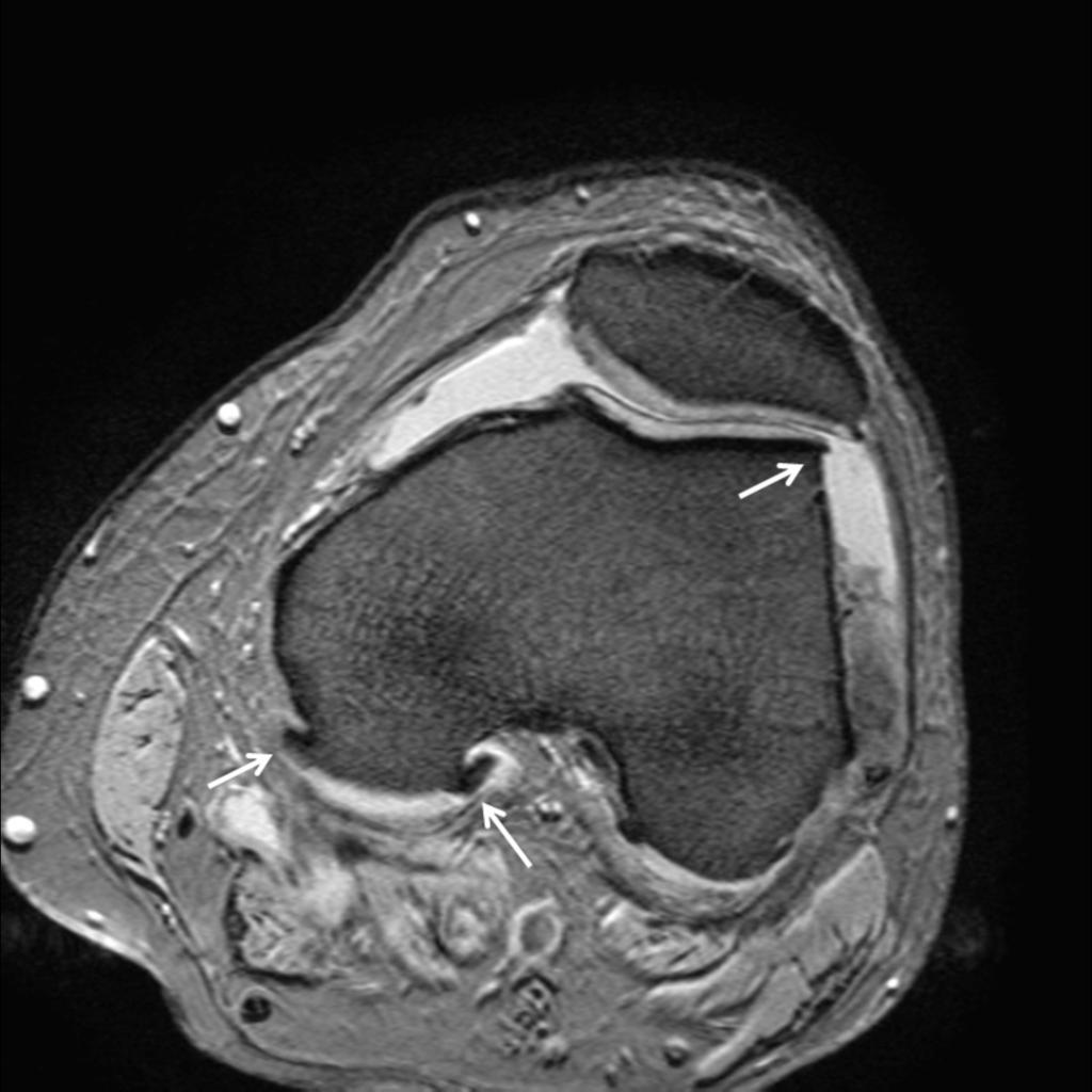 Fig. 5: 5. Axial T2* image of the knee shows overhanging osteophites (white arrows) and joint effusion.