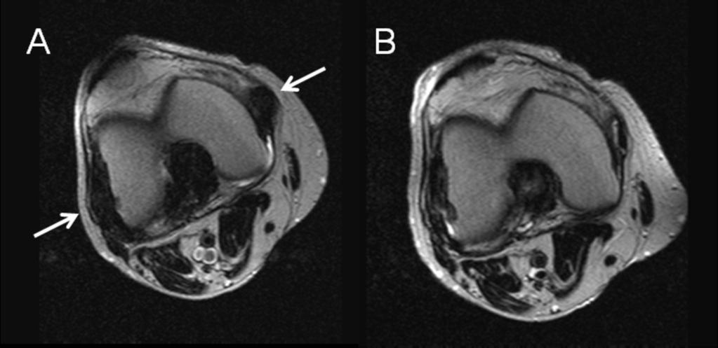 Fig. 6: 6. Monitoring gout during urate-lowering therapy, tophi measurement. A and B- Sagital T2 weighted images of the knee.