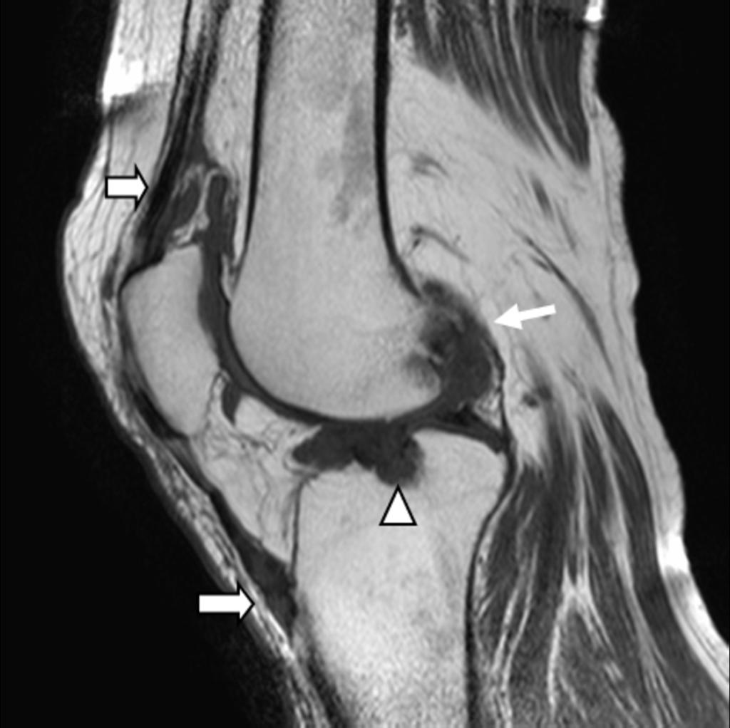 Fig. 1: 1. MRI of the knee. Patient with tophaceous gout.