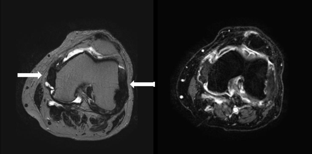 Fig. 3: 3. Left image: Axial T2 weighted image of the knee. Tophi in both collateral ligaments (white arrows) and underlying bone erosions.