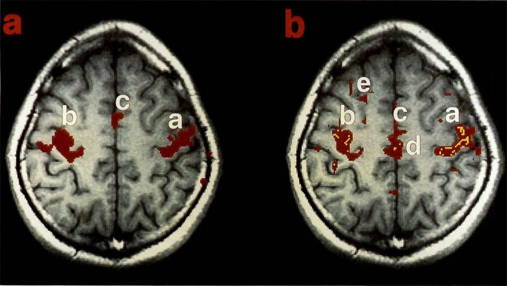 540 Biswal et al. FIG. 3. (Left) FMRI task-activation response to bilateral left and right finger movement, superimposed on a GFIASS anatomic image.