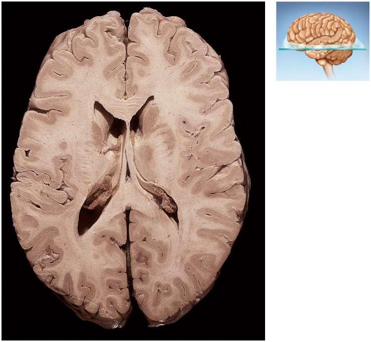 Ventricles of the Brain Rostral (anterior) Longitudinal fissure Frontal lobe Gray matter (cortex) White matter Lateral ventricle Temporal lobe Third ventricle Lateral sulcus Corpus callosum