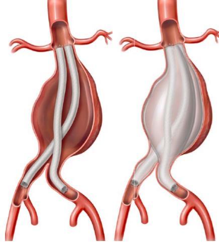 EndoVascular Aneurysm Sealing System is an investigational device in the United States, limited by federal (or United States) law to investigational use only.